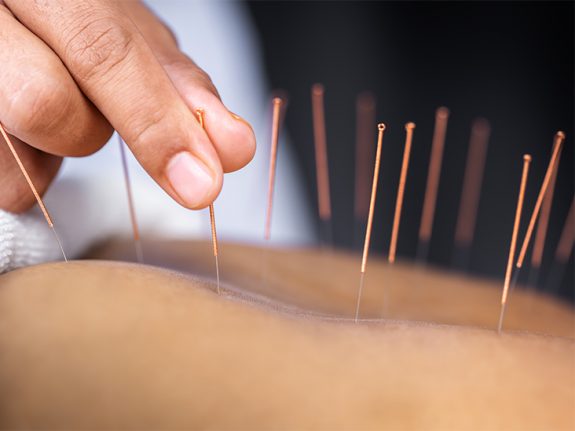 See how Acupuncture works and the benefits in it