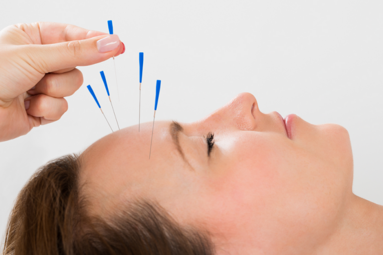 Women receiving Acupuncture for her migraines